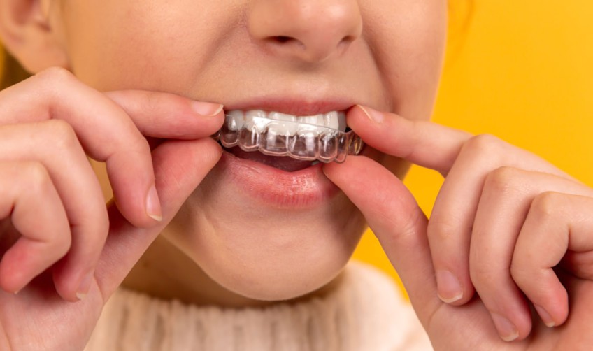 Blanqueamiento dental: separando mitos de realidades