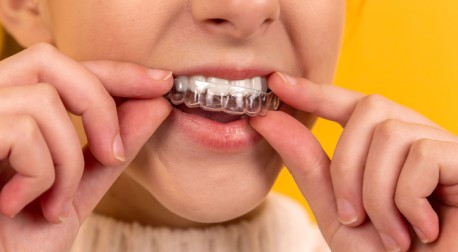 Blanqueamiento dental: separando mitos de realidades